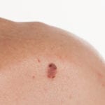 Basal Cell Carcinoma Long Beach, CA