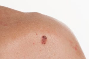 It’s Just Squamous Cell Carcinoma - American Society for Mohs Surgery