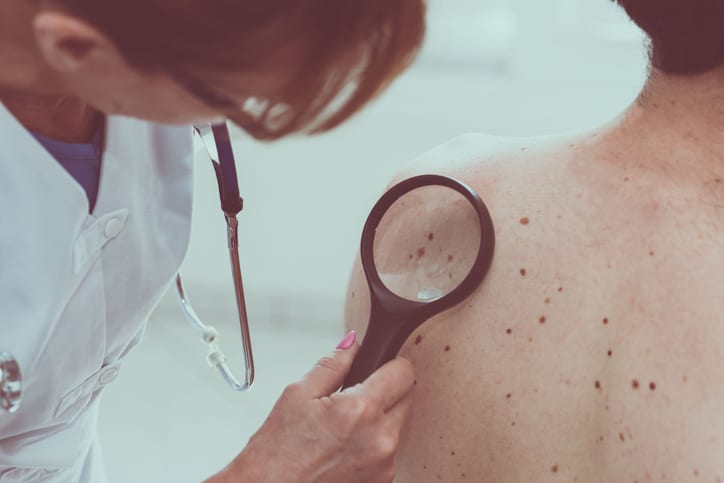 Melanoma Skin Cancer Treatment Houston TX