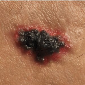 Melanoma | Melanoma Symptoms | American Society for Mohs Surgery