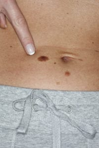 Melanoma on a woman's belly that should be inspected by a dermatologist.