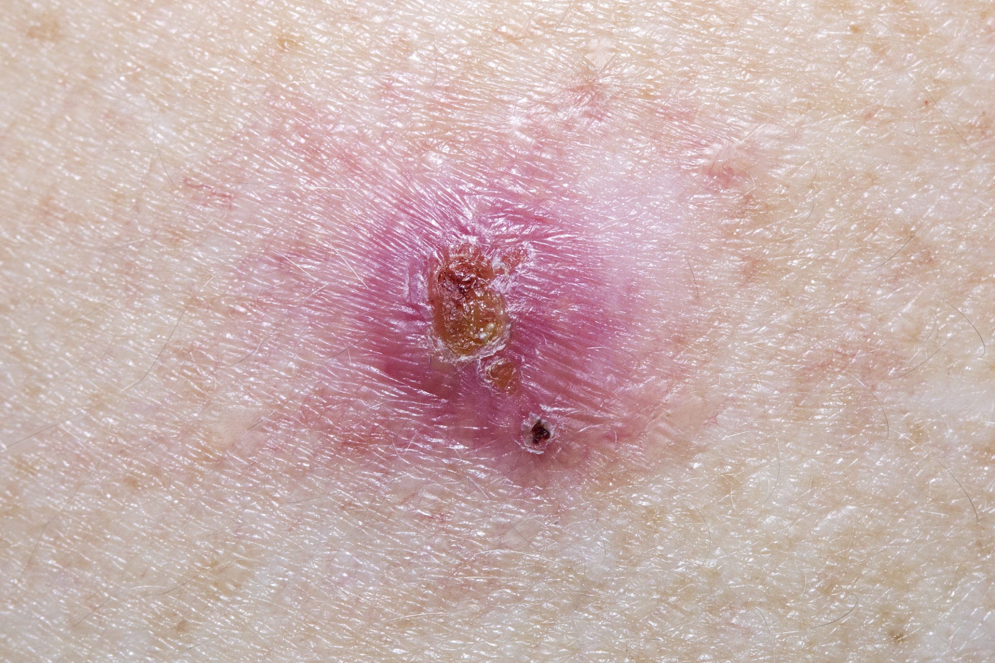 Basal Cell Carcinoma - pre-removal of a suspicious dark brown mole on the abdomen of a young woman.