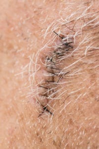 Mohs surgery incision on side of caucasian male face.