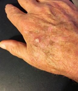 Actinic keratosis - a precursor to squamous cell carcinoma or skin cancer on a man's hand