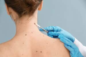 Skin Cancer Treatment Houton TX